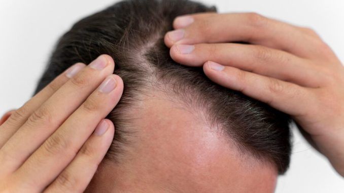 Mejora la salud de tu cabello con crioterapia capilar en Vitoria