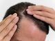 Mejora la salud de tu cabello con crioterapia capilar en Vitoria
